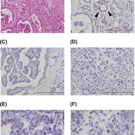 Microscopic Findings Of The Lung Metastatic Tumor At Autopsy A