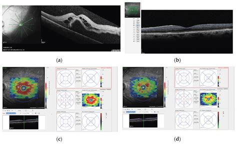 A Preoperative Infrared And Sd Oct B Scan Images Of A Patient With