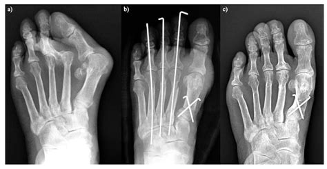 IJERPH Free Full Text Joint Preserving Surgery For Forefoot