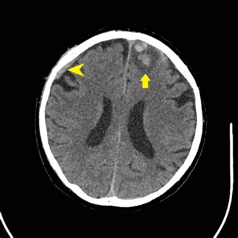 Traumatic Brain Injury CT Wikidoc