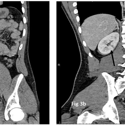 A Grade 1 Liver Laceration A Highlighted In The Solid Black Circle