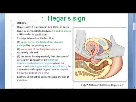 Obstetrics 095 Hegars sign pregnancy uterus fingers appose bimanual ...