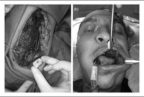 Figure From Medial Femoral Condyle Flap For Persistent Alveolar Cleft