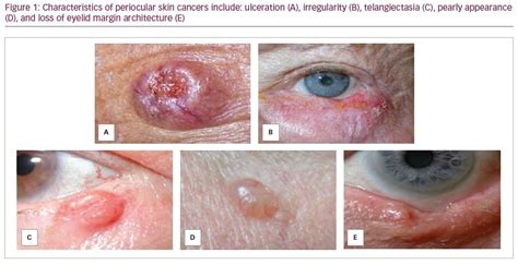 Clinical Features And Management Of Eyelid Malignancies Touchophthalmology