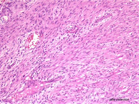 Enchondroma Vs Grade I Chondrosarcoma Classification Dataset By