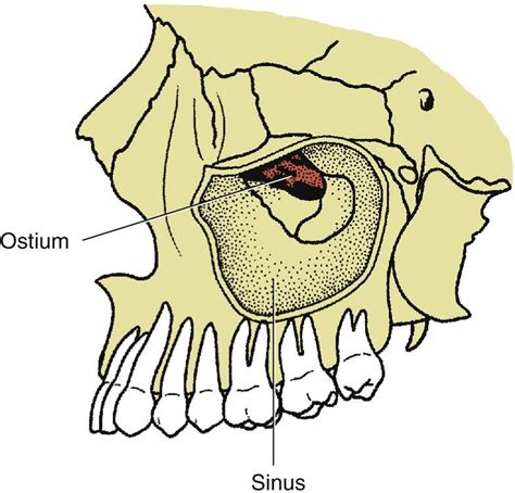 Odontogenic Diseases Of The Maxillary Sinus Clinical Tree