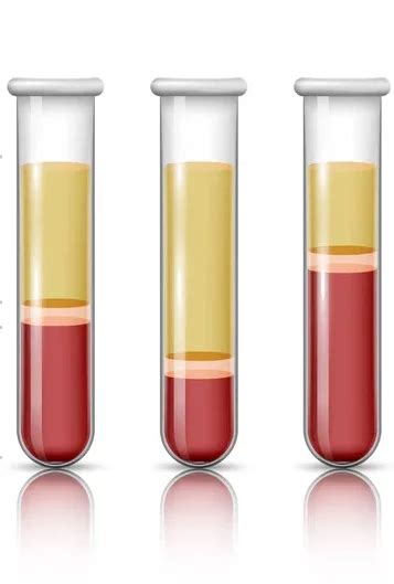 Hematocrito, ¿Cuál es su valor? - Homo medicus