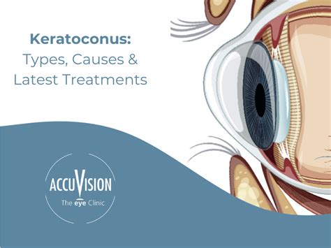 Keratoconus Treatment Causes Diagnosis And Treatment Options