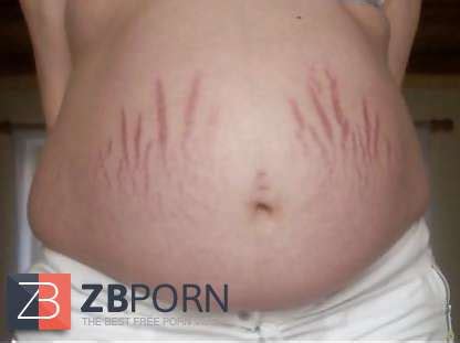 Vergeture Grossesse ZB Porn
