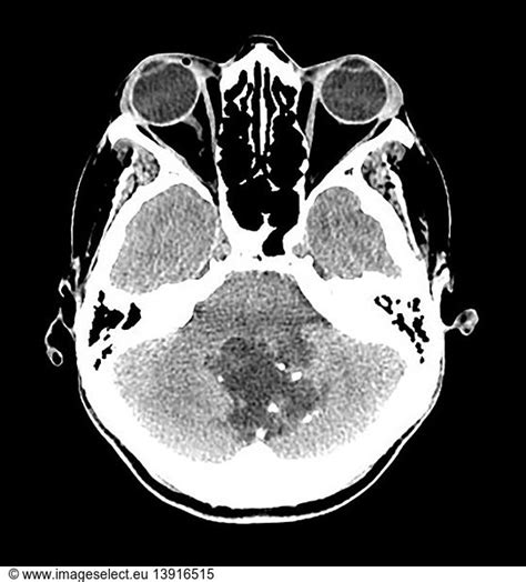 Fourth Ventricular Epidermoid Cyst Fourth Ventricular Epidermoid Cyst