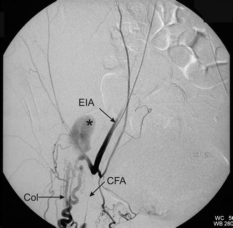 Retroperitoneal Hematoma After Diagnostic Coronary Angiography Caused