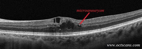 Diabetic macular edema (DME, CSME) - Optical Coherence Tomography Scans