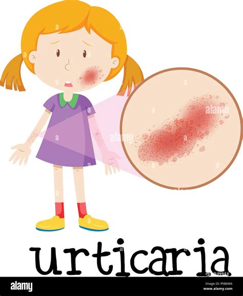 Una Niña Con Urticaria En La Piel Ilustración Imagen Vector De Stock Alamy