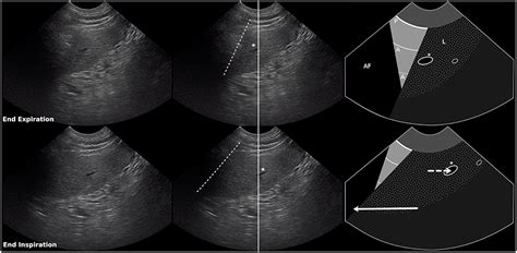 Frontiers Abnormal Curtain Signs Identified With A Novel Lung