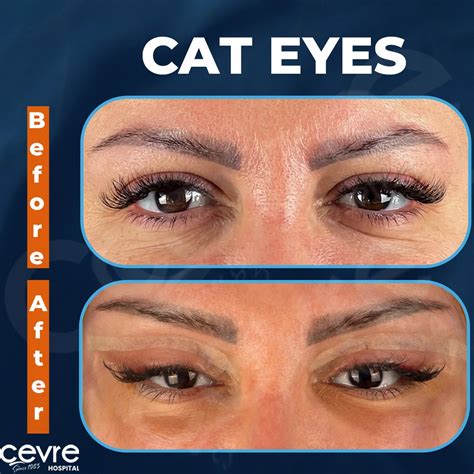 2024 Cat Eye Lift Canthoplasty In Istanbul Turkey Cost And Updates