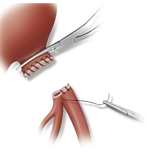 Figure From Surgical Internal Iliac Artery Preservation Associated