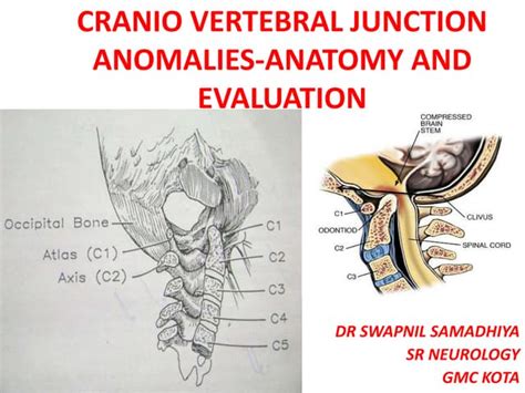 Craniovertebral Junction Ppt