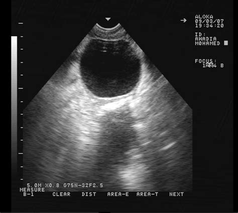 Serous Cystadenocarcinoma Ultrasound