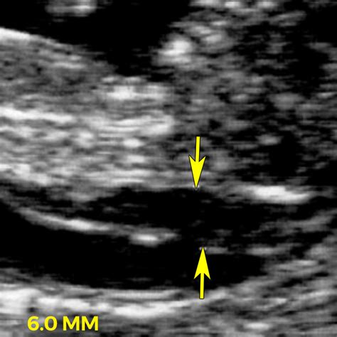 Nuchal translucency (NT) ultrasound - BabyCenter Canada