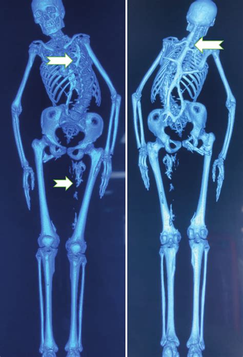 Whole Body Computerised Tomography Ct With Three Dimensional Download Scientific Diagram