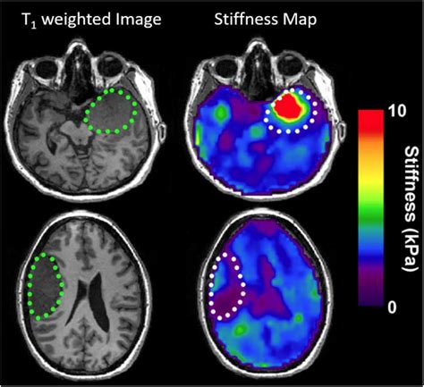 Magnetic Resonance Elastography Of The Brain Magnetic Resonance