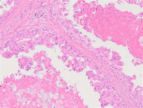 Apocrine Dcis Bosnianpathology