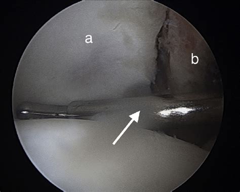 The Glenoid Surface A The Coracoid Block B Is Placed On To The Download Scientific Diagram