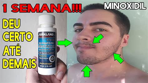 MINOXIDIL RESULTADO EM 1 SEMANA É possivel isso SIM OU NÃO