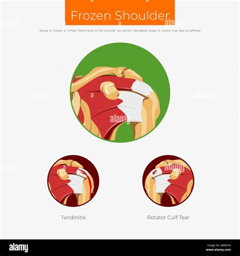 Póster de esquema de anatomía de hombro congelado Imagen Vector de