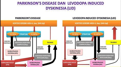 Video 52 Parkinson S Disease Dan Levodopa Induced Dyskinesia LID