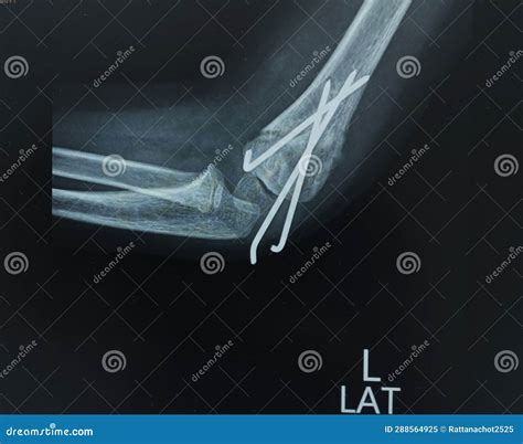 X Ray Left Elbow Ap Cross Table View Supracondylar Fracture Of The