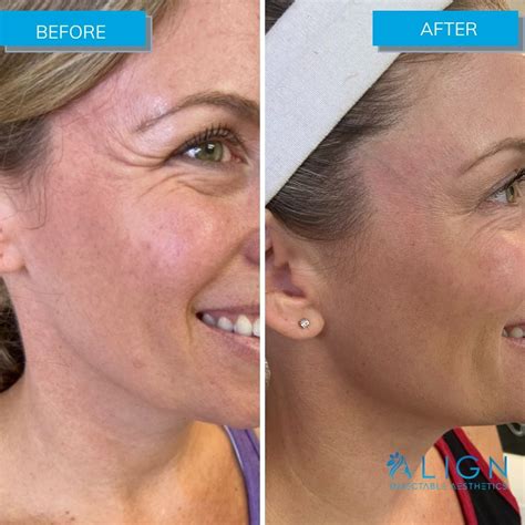 Xeomindysportbotox Archives Align Injectable Aesthetics