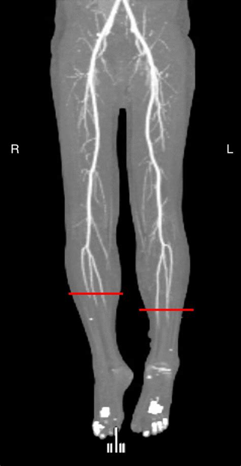 Repeat Ct Angiography Of The Lower Limbs Week Later During Acute