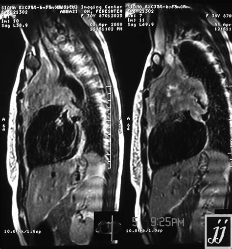 Mediastinal mass – Radiopaedia