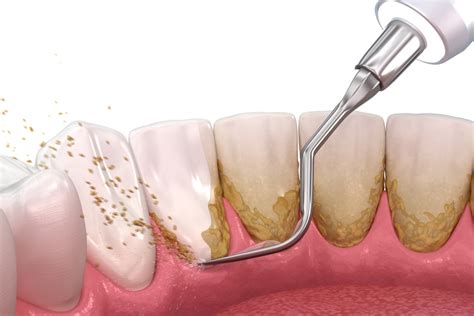 Periodontal Scaling & Root Planing | Orland Park, IL | Dental Arts of ...