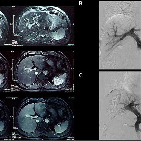 A Magnetic Resonance Imaging Mri Before Pve In Different Phases B