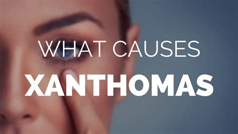 What Causes Xanthomas And Xanthelasma Watch To Find Out Youtube