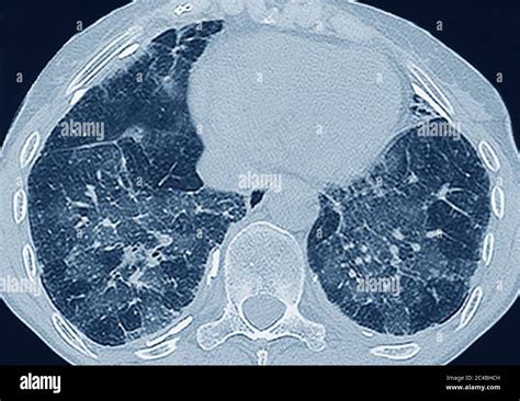 Fibrosis pulmonar histologia Banque de photographies et dimages à