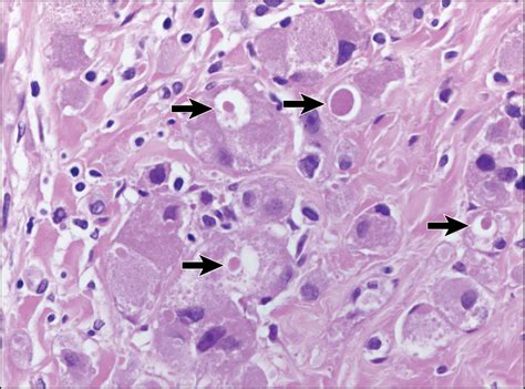 Solitary Cerebriform Nodulequiz Case Dermatology Jama Dermatology