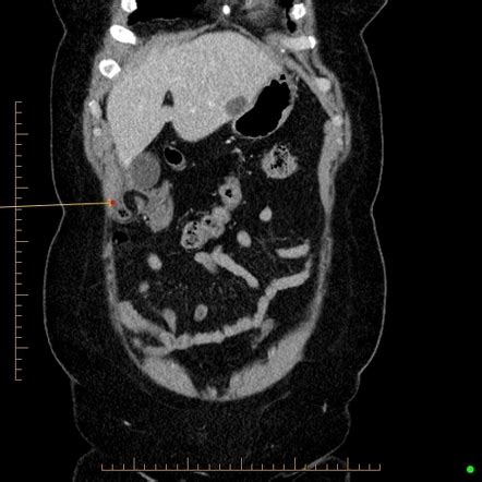 Subhepatic Appendicitis Radiology Reference Article Radiopaedia Org