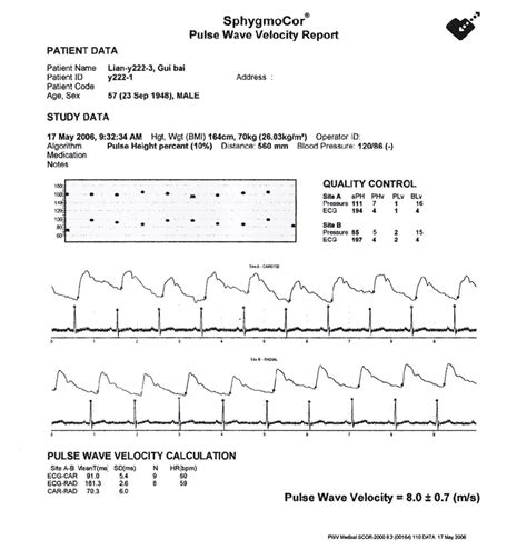 Measurement Of Pulse Wave Velocity A And Aortic Augmentation Index Download Scientific