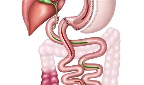 Duodenal Switch Surgery: Costs, Success Rates, Risks & Complications