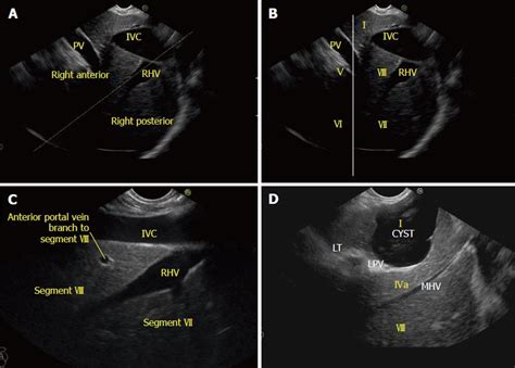 Liver Segment 7 Ultrasound