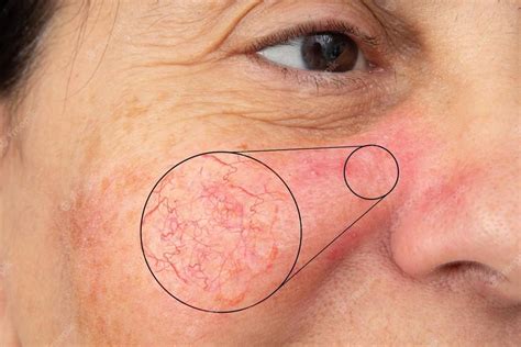 Rosacea What Is It And How Is It Treated Elevation Dermatology