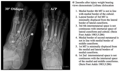 Lisfranc Fracture Dislocation S93326a 83803 Eorif