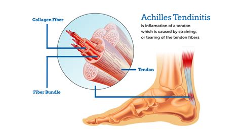 Achilles Tendinitis Hartford County Ct Advanced Foot And Ankle Specialists