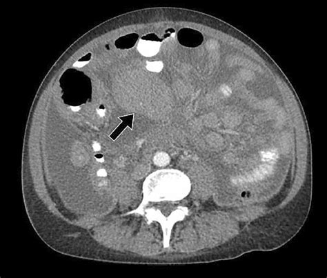 Peritoneal Lymphomatosis With Ascites Axial Contrast Enhanced Ct Image