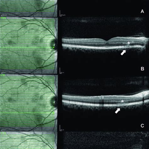 Spectral Domain Optical Coherence Tomography At Presentation Revealing