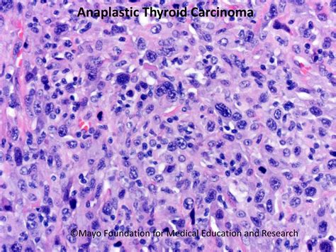 Anaplastic Thyroid Carcinoma Mayo Clinic Proceedings