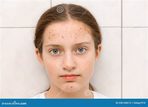 Face Of A Teenage Girl With Pimples Acne On The Skin Portrait Of Puberty Girl Stock Image